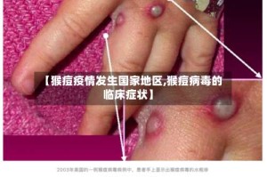【猴痘疫情发生国家地区,猴痘病毒的临床症状】