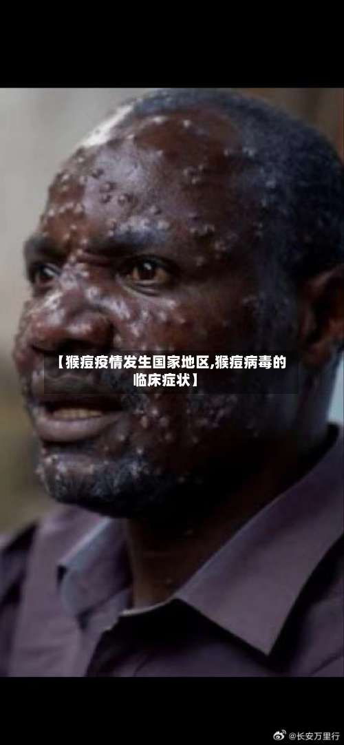 【猴痘疫情发生国家地区,猴痘病毒的临床症状】-第3张图片