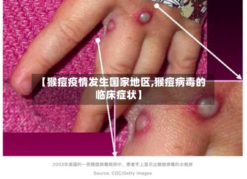【猴痘疫情发生国家地区,猴痘病毒的临床症状】-第1张图片